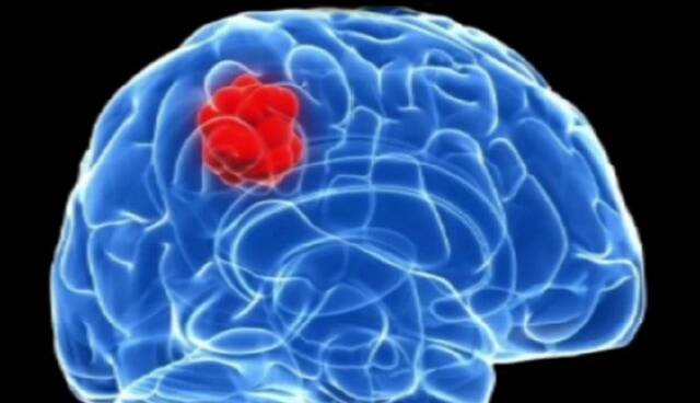 یک داروی موثر در درمان سرطان مغز