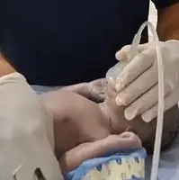 لحظات دلهره آور از تلاش‌های پزشک برای نوزادی که قلبش نمی‌زند!