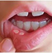 درمان آفت دهان کودکان!