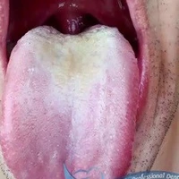 مقابله با عفونت دهان
