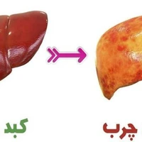 اهمیت بالای کبد در بدن و درجه بندی چربی کبد