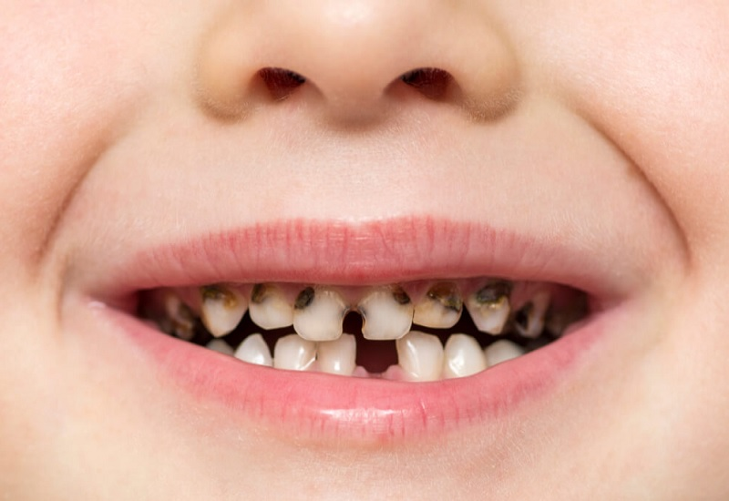 زمان اولین مراجعه به دندانپزشک برای کودکان