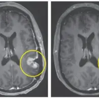 یک درمان جدید تومور مغزی را در عرض تنها ۵ روز از بین برد