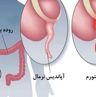 چگونگی جراحی و خارج سازی آپاندیس    