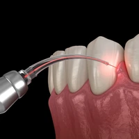 سلاح لیزری برای از بین‌ بردن باکتری‌های دندان!