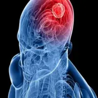 ارتباط داروهای هورمونی ضد بارداری با تومورهای مغزی