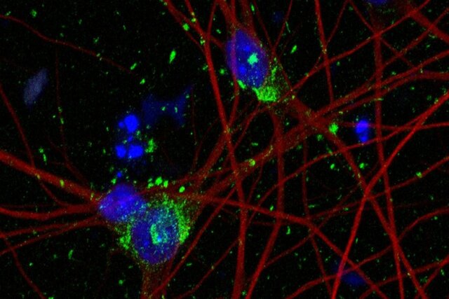 امید به درمان آلزایمر با مدل‌سازی جدید از نورون انسان