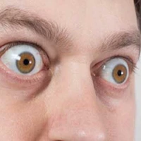 بیماری بیرون‌زدگی چشم چیست؟