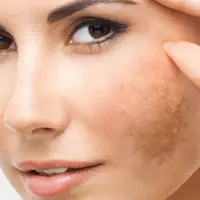 مهم‌ترین دلایل بروز لکه‌های پوستی