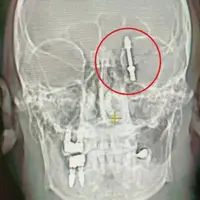 4گوشه دنیا/ دندانپزشک ترکیه ای ایمپلنت را در مغز بیمار فرو کرد! 