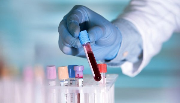 آزمایش خون ممکن است آرتروز زانو را پیش‌بینی کند