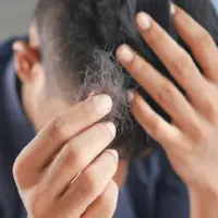 یک درمان جدید برای رویش مجدد موی بیماران خودایمنی
