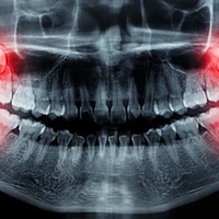باورهای غلط در مورد دندان عقل؛ چه زمانی برای کشیدن آن اقدام کنیم؟