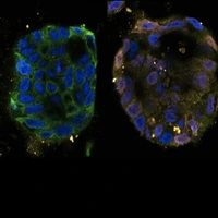 کشف مسیر جدیدی از مرگ سلول‌های سرطانی برای اولین بار