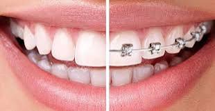 ارتودنسی دندان برای چه کسانی توصیه می‌شود؟