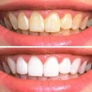 ۷ دلیل اصلی زرد شدن دندان ها