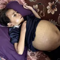 شکم غیرعادی کودک فلسطینی که بسیار بزرگ است