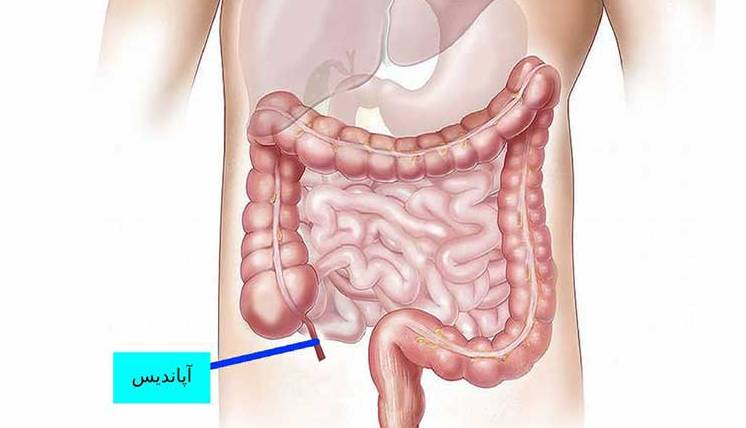 دلایل اصلی بروز درد آپاندیس