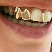 خوش به حال افرادی که دندان طلا دارند!