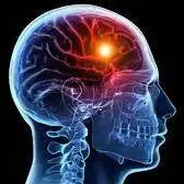 علائم و نشانه‌های سکته مغزی