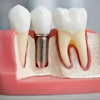 ساخت ایمپلنت دندانی جدید