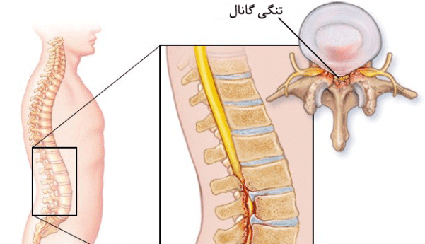 مهم ترین علل ایجاد تنگی کانال نخاعی