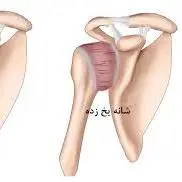 کم هزینه ترین درمان بیماری شانه یخ زده