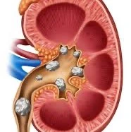 رفع فوری درد سنگ کلیه در خانه