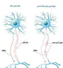 پژوهش‌های ویژه متخصصان طب ایرانی درباره بیماری ام اس