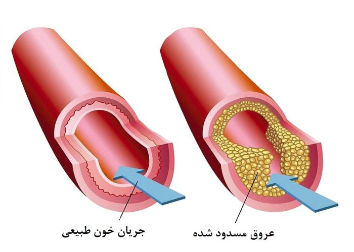 درمان انسداد عروق و چالش‌های آن