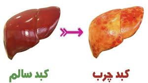 استرس ها به روی کبد چرب هم تاثیرگذار است