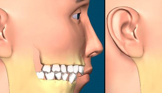 درمان صدای مفصل فک را جدی بگیرید
