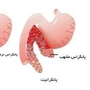 مهم‌ترین علائم التهاب پانکراس