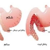 شایع‌ترین دلایل التهاب پانکراس