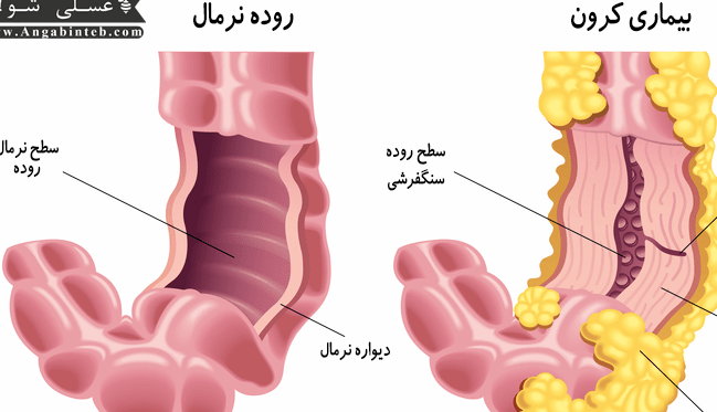 کرون یک نوع بیماری التهابی دستگاه گوارش است