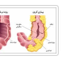 کرون یک نوع بیماری التهابی دستگاه گوارش است