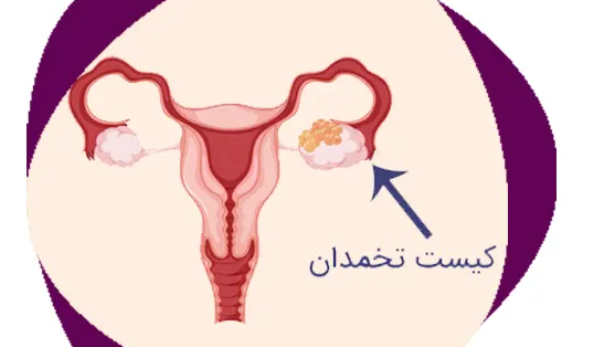 روش تشخیص کیست تخمدان