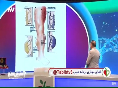 ضایعات مادرزادی وریدی و درمان آن