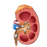 کلیه‌های سنگ‌ساز و درمان آن