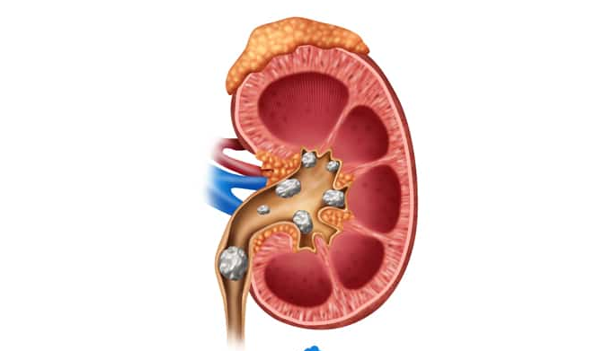کلیه‌های سنگ‌ساز و درمان آن