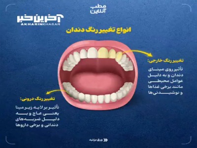 با تغییر رنگ دندان‌ها چه کنیم؟