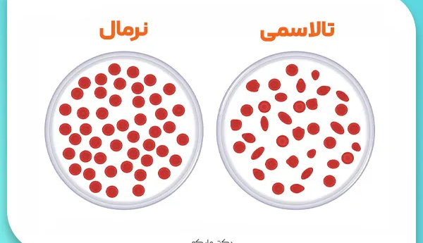 کاهش تولد مبتلایان به تالاسمی در کشور