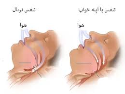 آپنه خواب چیست؟