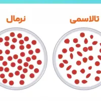 کاهش تولد مبتلایان به تالاسمی در کشور