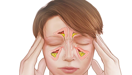 راه حل درمان فوری سینوزیت چیست؟