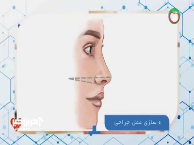 شبیه‌سازی عمل جراحی بینی