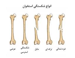 انیمیشن سه بعدی چگونگی ترمیم استخوان شکسته