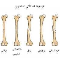 انیمیشن سه بعدی چگونگی ترمیم استخوان شکسته