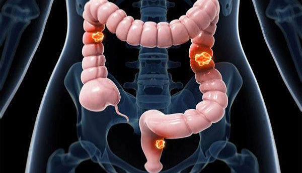 8 ماده غذایی برای پیشگیری از یک نوع سرطان گوارشی