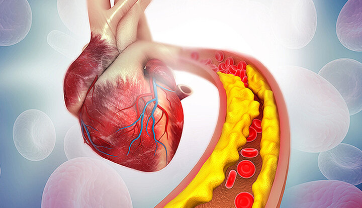 کلسترول خون را چه‌طور کاهش دهیم؟